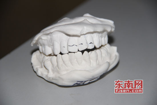 莆田口腔医院遭质疑 牙齿矫正后出现牙龈萎缩